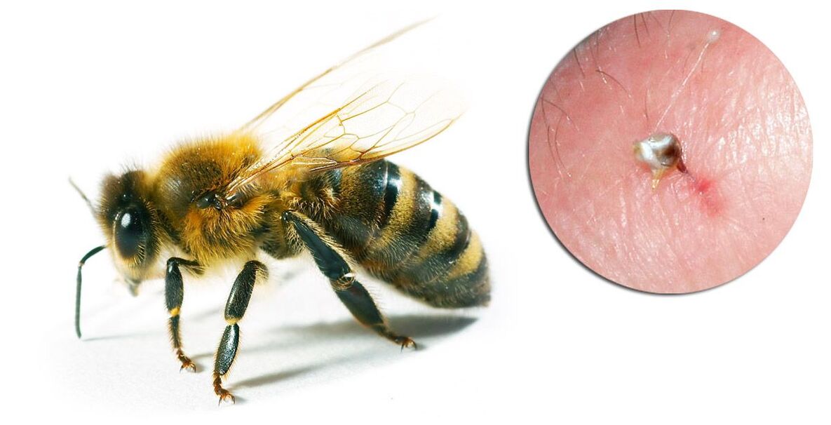 Hondrostrong contém veneno de abelha, que melhora os processos metabólicos nos tecidos