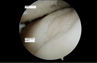 vista astroscope na articulação do joelho com a osteoartrite de 3º grau