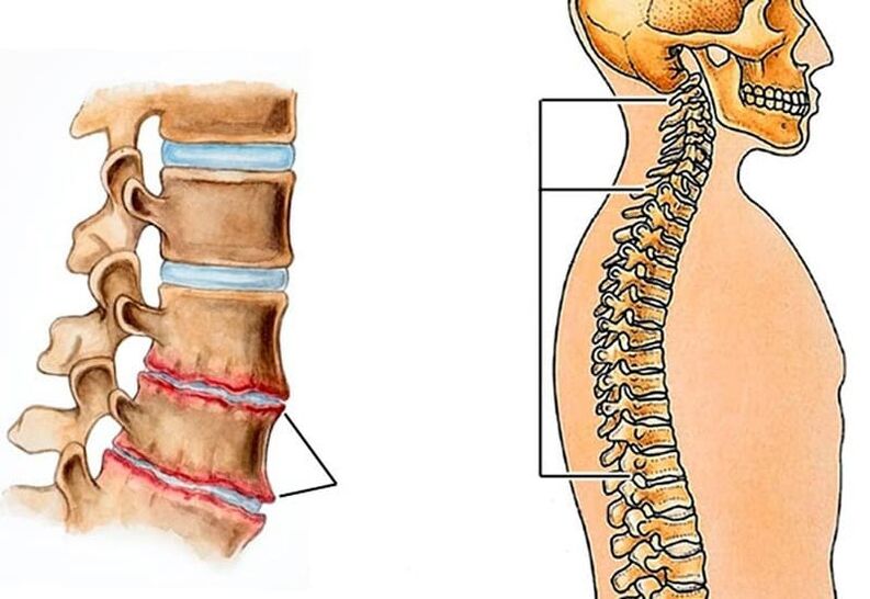 curvatura da coluna vertebral leva a dores nas costas