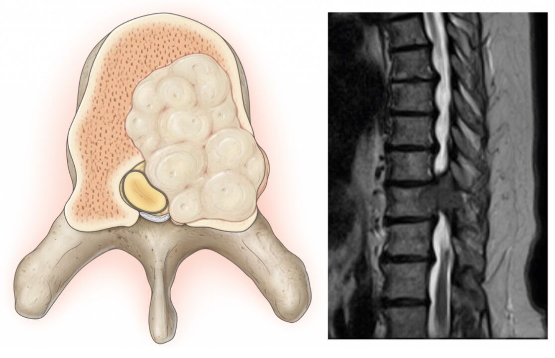 inchaço na coluna vertebral causa dor nas costas