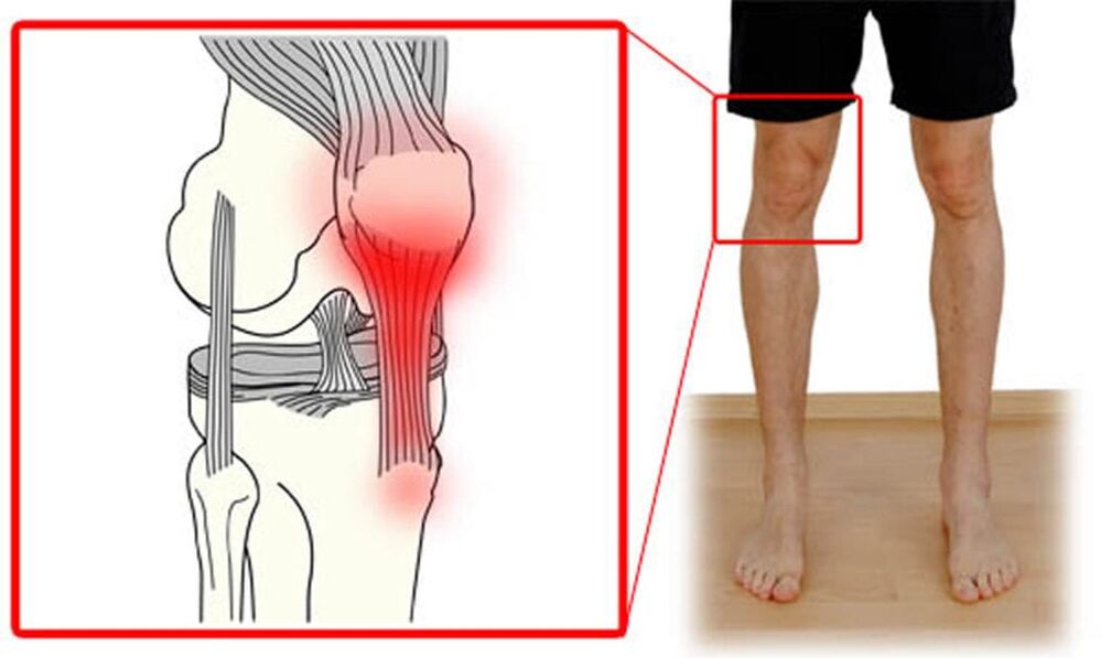 Tendinite - inflamação dos tendões na articulação do joelho