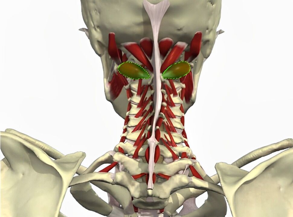 síndrome da artéria vertebral