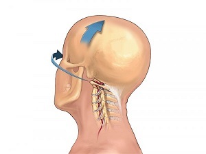 como a osteocondrose da coluna cervical se manifesta