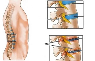 causas de osteocondrose da coluna lombar