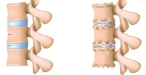 como reconhecer a presença de osteocondrose da coluna lombar