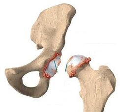 causas de artrose da articulação do quadril