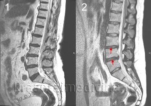 osteocondrose da coluna vertebral