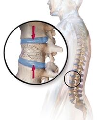 A osteoporose provoca dores nas costas na região lombar